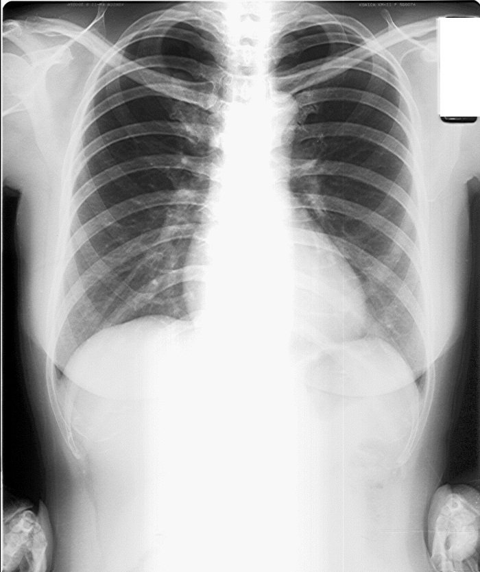 lung nodule01